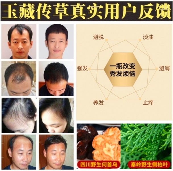 Hair Growth Essence Hair Care Anti Hair Loss Chinese Medicine Extract for Unisex