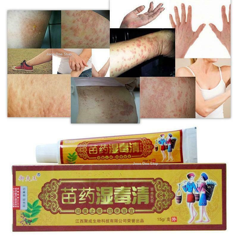 Natural Chinese Herbal Anti Itching Cream King Yu Fu/Acne Cream/Eczema ...